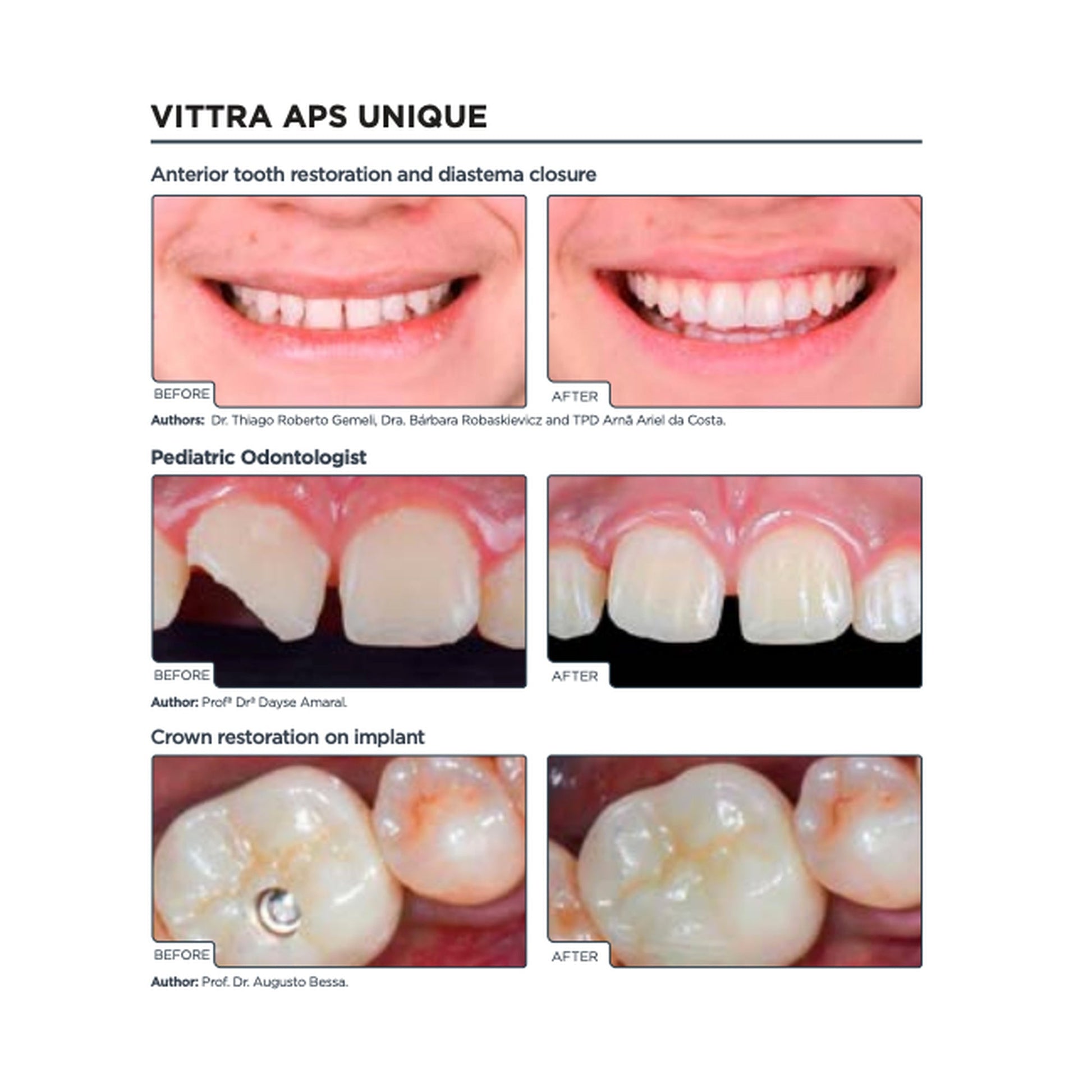 FGM Dental Vittra APS Unique anterior pediatric and implant restoration clinical cases