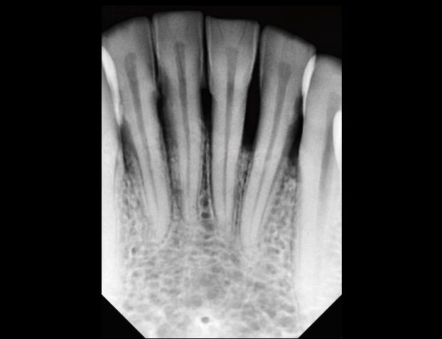 Vatech EzRay Air Wall