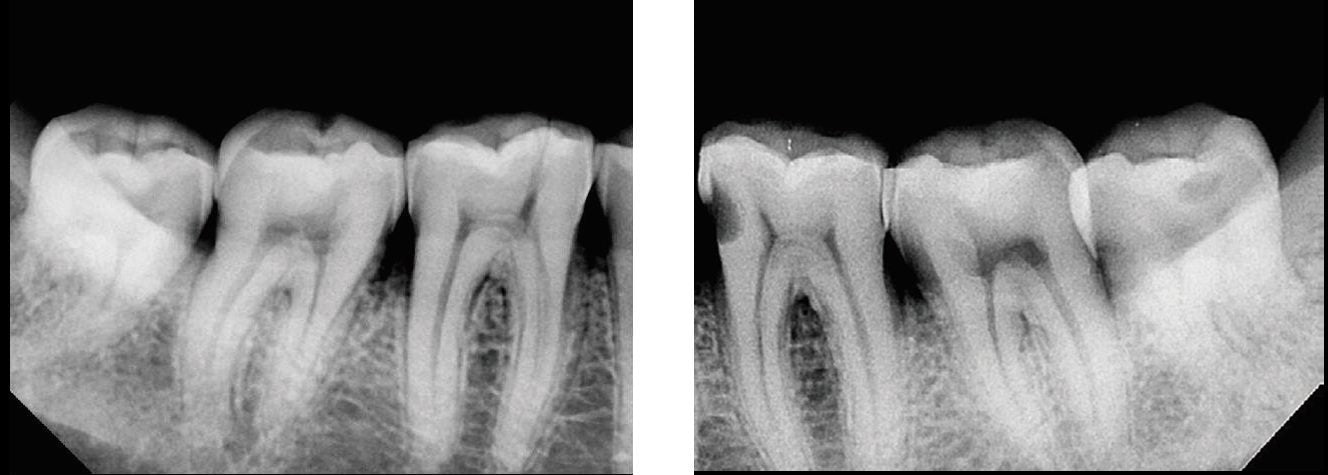 Vatech EzRay Air Wall